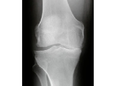 Diagnosticul artrozei articulației genunchiului