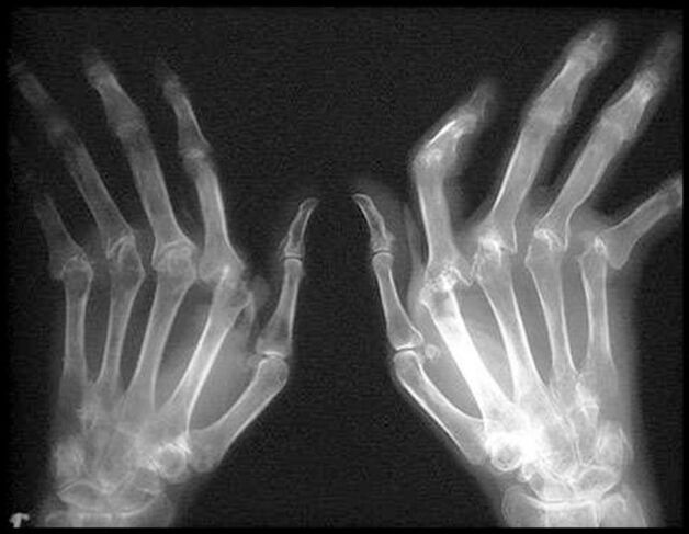 X -RAY Imaginea mâinilor afectate de artroză