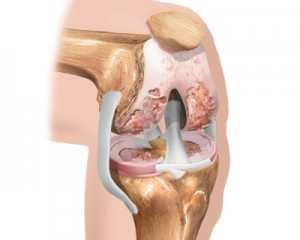 stadiul inițial al artrozei genunchiului