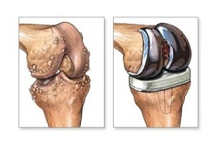 înlocuirea genunchiului pentru artroză