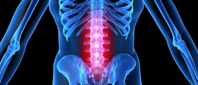 Deformarea discului intervertebral