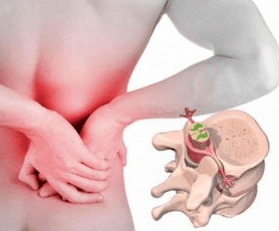 Lumbago la începutul osteochondrozei bolii