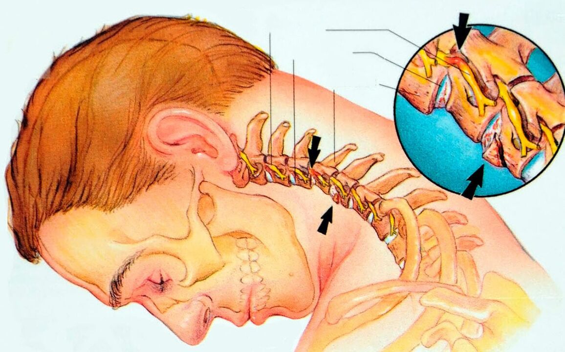Ce este osteochondroza cervicală