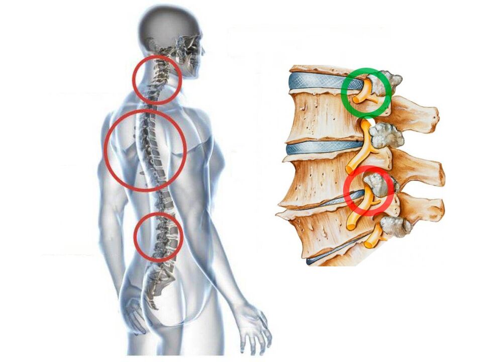 Cum arată osteocondroza cervicală a vertebrelor