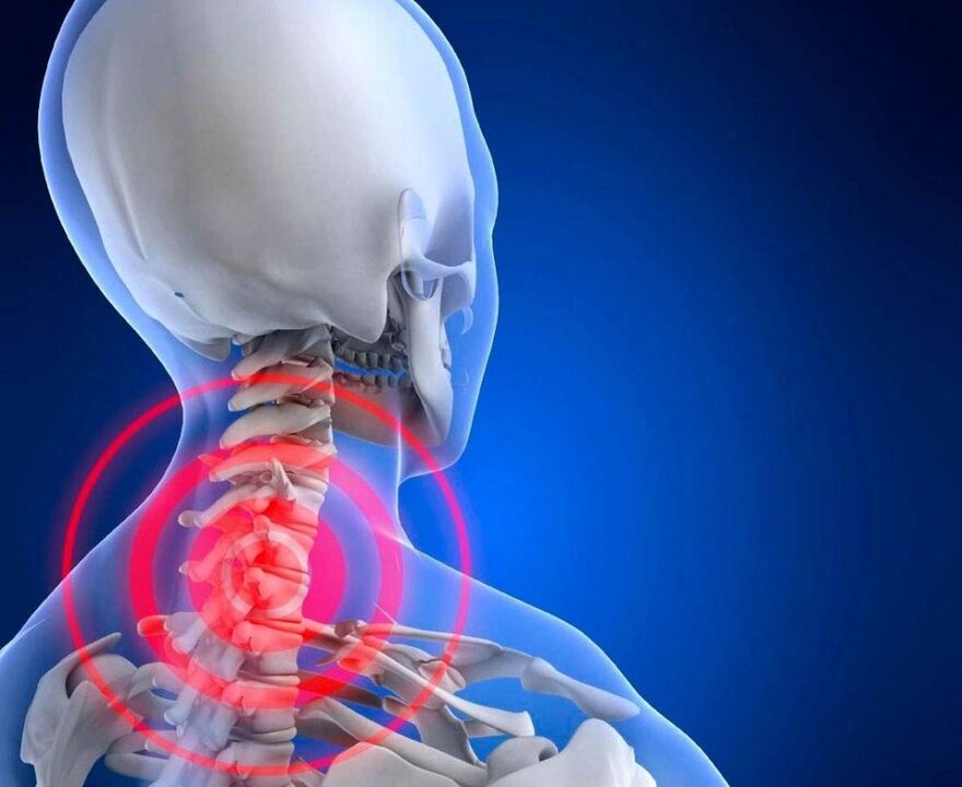 Dureri de gât cu osteochondroză cervicală
