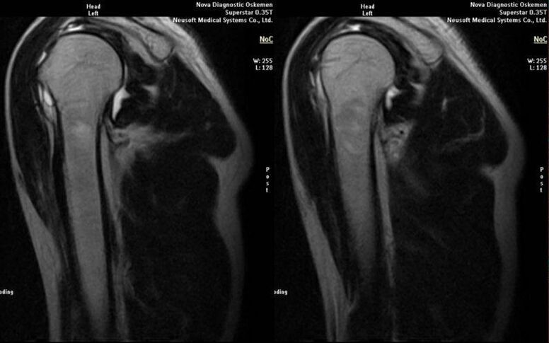 artroza articulației umărului la radiografie