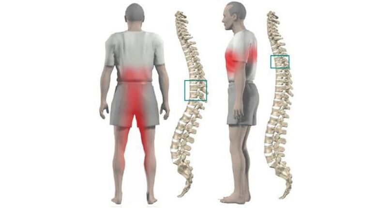 durere la nivelul corpului și coloanei vertebrale cu osteocondroză