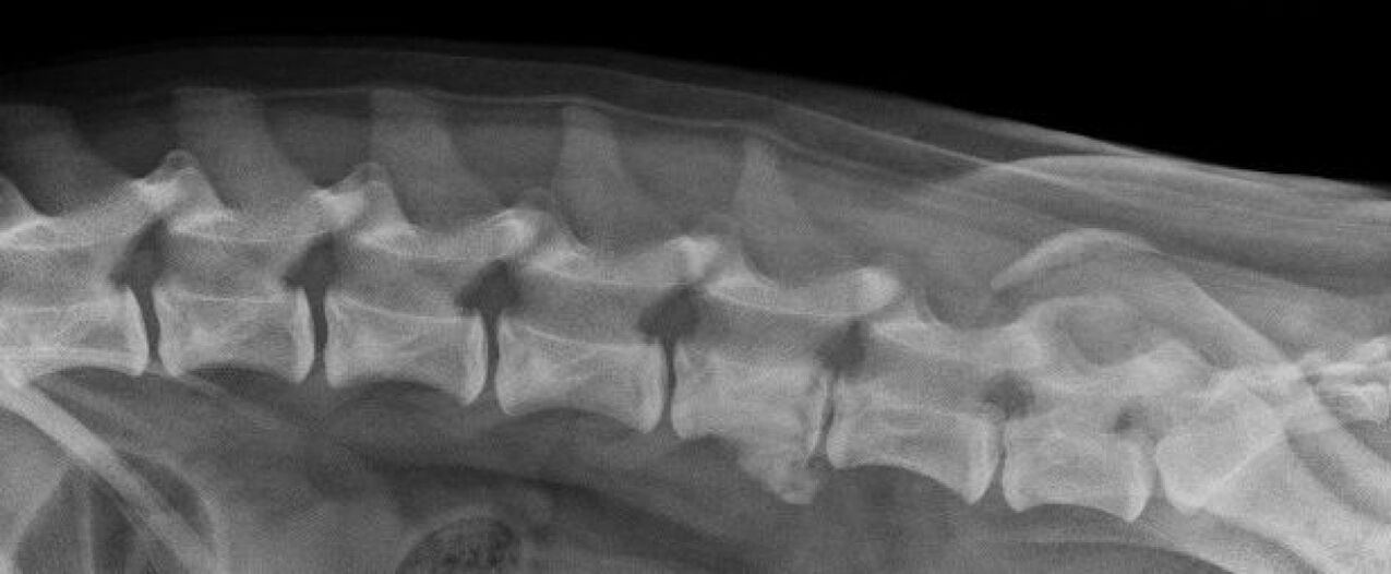 Manifestări de osteocondroză a coloanei vertebrale toracice pe o radiografie