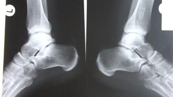 Diagnosticul artrozei gleznei folosind radiografie