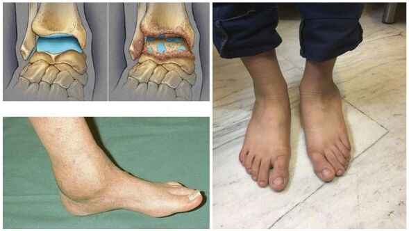 Umflarea și deformarea articulației gleznei din cauza artrozei